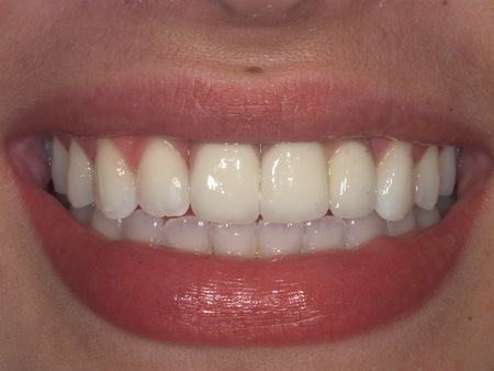 before after